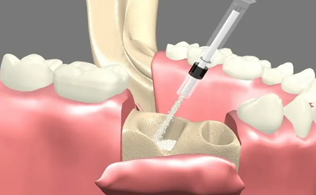 Bone Grafts