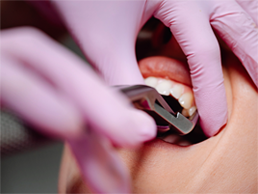 Wisdom Tooth Extraction